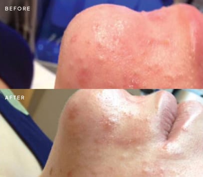 Acne and redness along the jawline before and after treatment