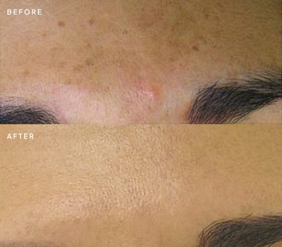 Brown spots on the forehead before and after treatment