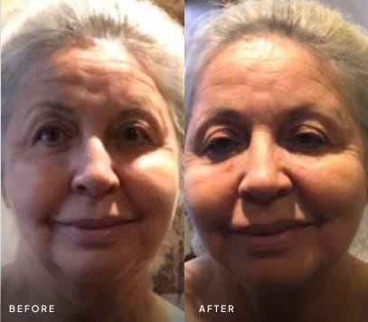 Woman’s face before and after facial rejuvenation treatment