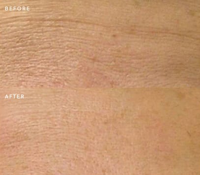 Forehead fine lines before and after treatment