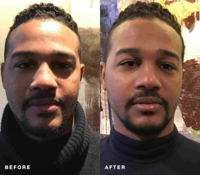 Hydrafacial client before and after treatment