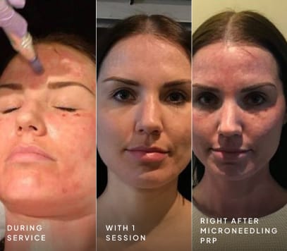 Microneedling with PRP during service, after one session, and right after treatment