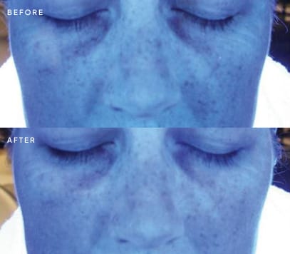 Skin analysis image of the cheeks before and after treatment